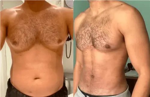 Read more about the article Gynecomastia in Dubai: Why Early Treatment Matter