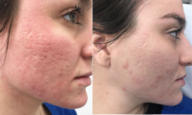 Acne Scar Removal Dubai: How to Achieve Clearer Skin