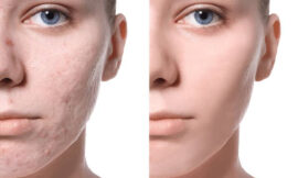 Acne Scar Treatment for Sensitive Skin: Options in Dubai