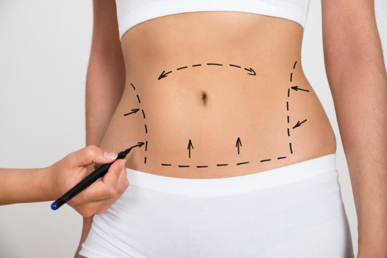 Read more about the article Bariatric Surgery and Skin Changes Dealing with Excess Skin After Weight Loss