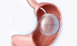 Can the Gastric Balloon Help You Achieve Your Weight Loss Goals in Dubai