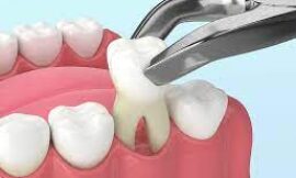 Cheap Tooth Extraction in Dubai What Are Your Options