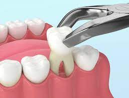 Read more about the article Cheap Tooth Extraction in Dubai What Are Your Options