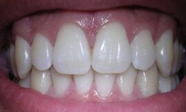 Why D3 and K2 Are Vital for Teeth Health and How to Include Them in Your Diet?