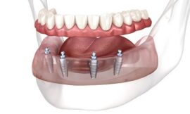 Why Dental Implants Are the Gold Standard in Tooth Replacement