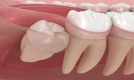 Tooth Extractions for Braces, What You Should Know