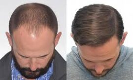 Financing Your Hair Transplant in Dubai: Cost Considerations and Options