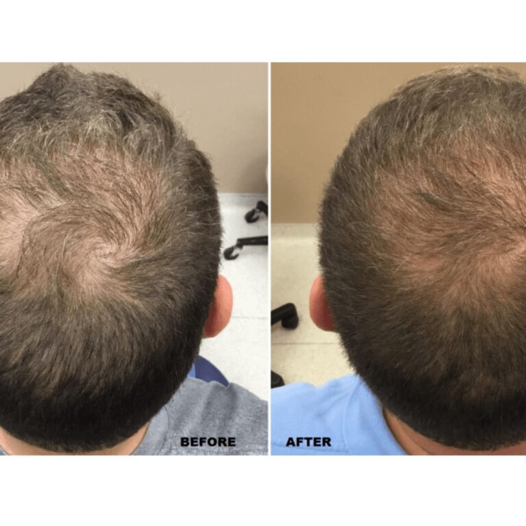 Read more about the article Top 3 Hair Loss Treatment Options in Dubai