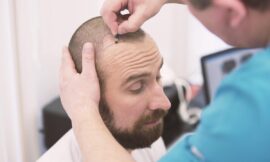 Best Hair Transplant in Dubai: Expert Solutions