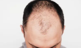 Invest in Your Hair: Dubai Hair Transplant Costs