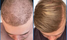 Hair Transplant in Riyadh: The Ultimate Solution for Thicker, Fuller Hair