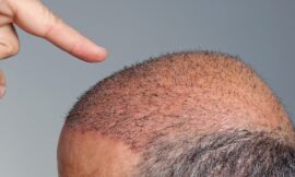 Why Choose a Hair Transplant Over Other Options?