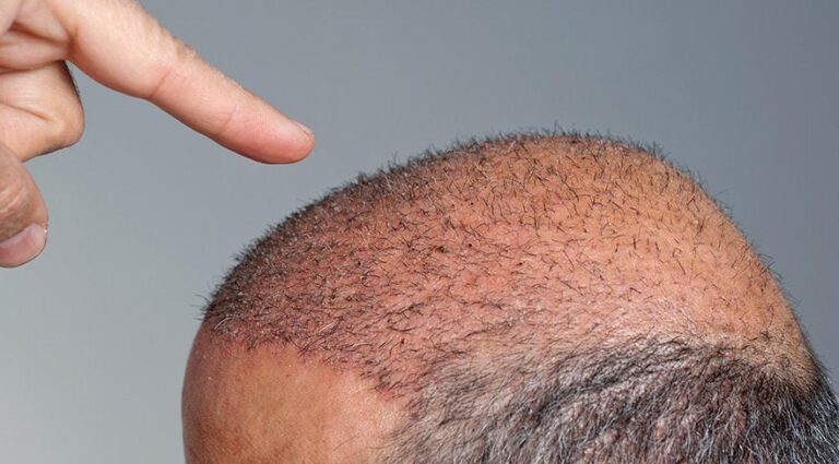 Read more about the article Why Choose a Hair Transplant Over Other Options?