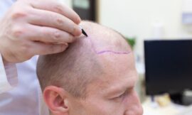 Why Women Are Turning to Hair Transplants for Hair Loss