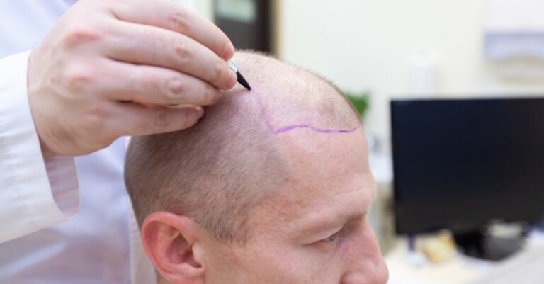 Read more about the article Why Women Are Turning to Hair Transplants for Hair Loss