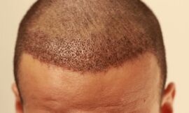 What To Expect After A Hair Transplant Surgery