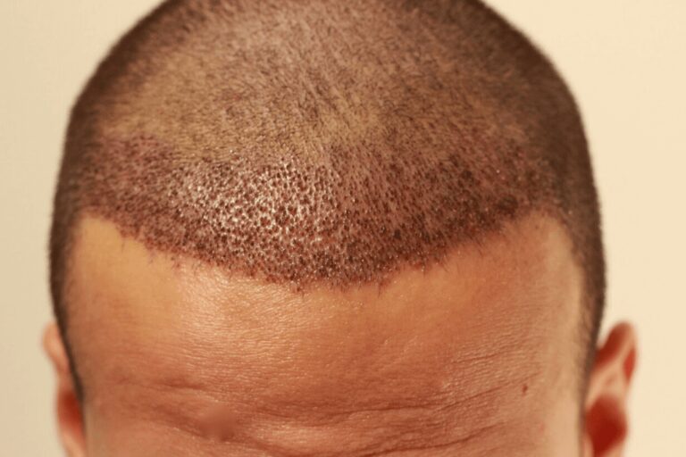 Read more about the article What To Expect After A Hair Transplant Surgery