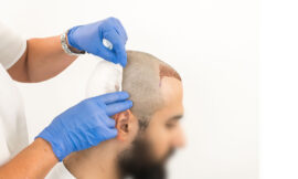 How Hair Transplants Can Restore Your Confidence