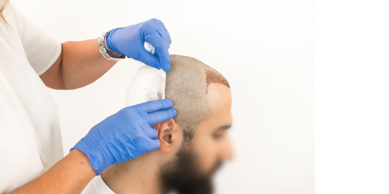 Read more about the article How Hair Transplants Can Restore Your Confidence