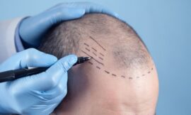 How Does a Hair Transplant Boost Your Confidence?