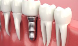 How Dental Implants Can Restore Your Smile and Confidence