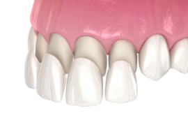 How Much Do Dental Veneers Cost in Different Countries