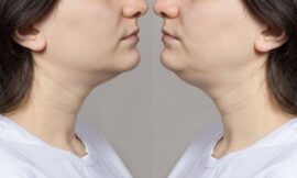 How Double Chin Liposuction Helps With Stubborn Fat Areas