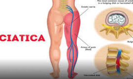 Physiotherapy for Sciatica: Pain Relief and Recovery Tips