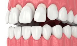 Is Getting Dental Veneers Painful? What to Expect During the Procedure