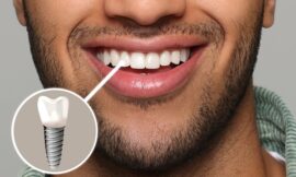 Is It Worth the Investment Dental Implant Costs in Dubai Explained