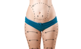 Is Liposuction in Dubai Suitable for Everyone Understanding Your Eligibility