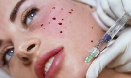 Is PRP the secret sauce to a ‘vampire facial’?