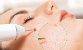 Laser Treatments for Warts Removal in Dubai Explained