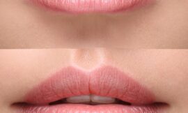 Lip Filler Injections vs. Lip Implants Which is Right for You in Dubai