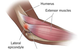 Does Pain O Soma 500 Help Heal Tennis Elbow Quickly?