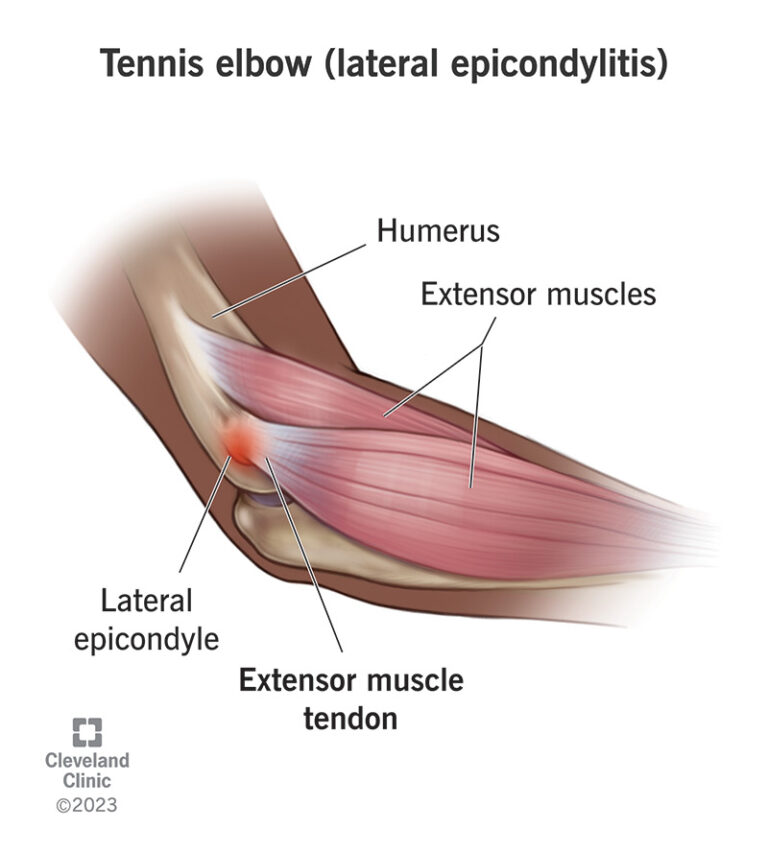 Read more about the article Does Pain O Soma 500 Help Heal Tennis Elbow Quickly?