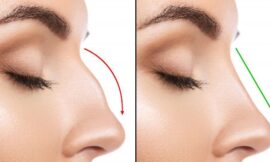 Rhinoplasty in Dubai for Different Age Groups: Who Can Benefit