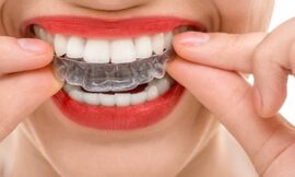 Why Braces Are Ideal for Overlapping Teeth Treatment