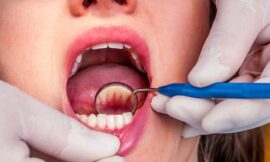 How Teeth Cleaning Helps Prevent the Development of Cavities