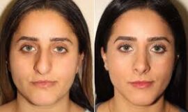 The Best Clinics for Rhinoplasty in Dubai: A Patient’s Guide