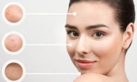 The Most Popular Acne Scar Treatments in Dubai You Should Consider