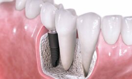 How Dental Implants Help Maintain Face Structure