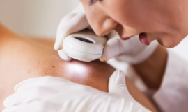 Non-Surgical Warts Removal Solutions in Dubai