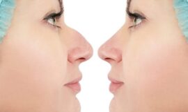 What Makes Dubai a Leading Hub for Rhinoplasty Procedures