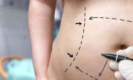 What to Expect During Your Tummy Tuck Recovery Journey