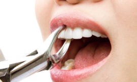 Where to Get the Cheapest Tooth Extraction in Dubai with Great Service