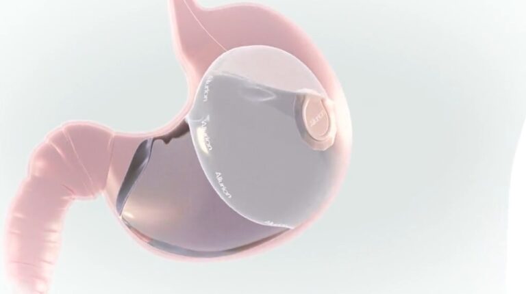 Read more about the article Gastric Balloon Placement: A Proven Method to Lose Stubborn Fat