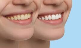 Brighten Your Smile Without Breaking the Bank