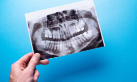 The Technology Behind Panoramic X-Rays: A Dental Revolution