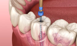 Posterior Root Canal for Infected Molars, A Lifesaver